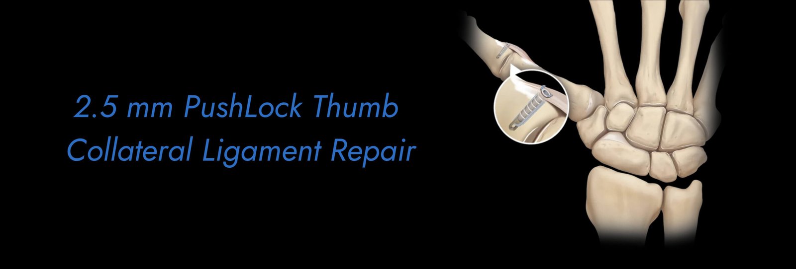 2.5-mm-PushLock-Thumb-Collateral-Ligament-Repair-scaled.jpg