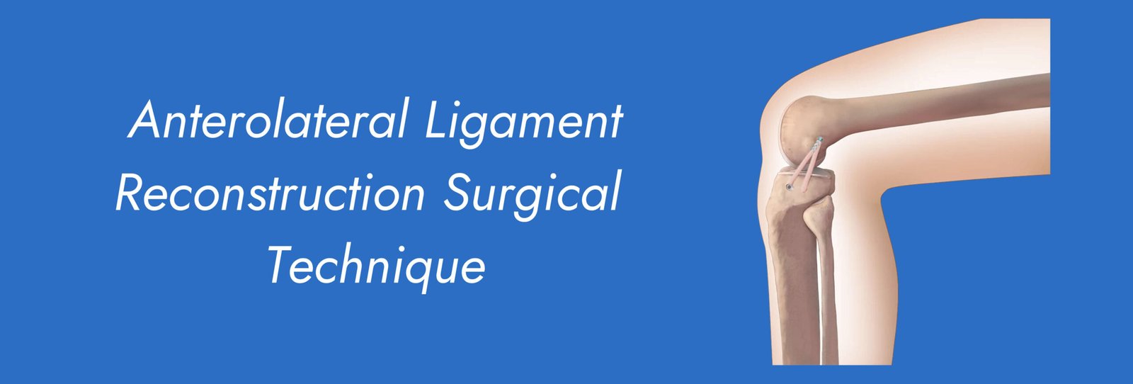 Anterolateral-Ligament-Reconstruction-Surgical-Technique-scaled.jpg