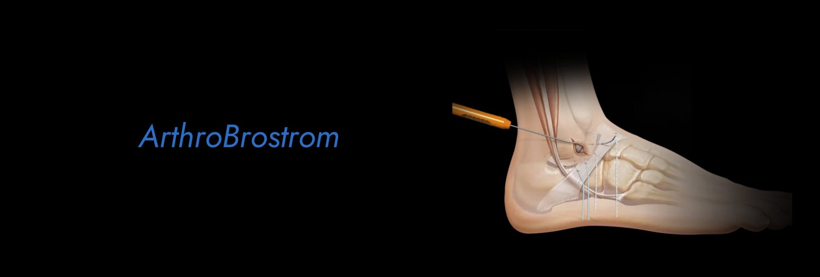 ArthroBrostrom-scaled.jpg