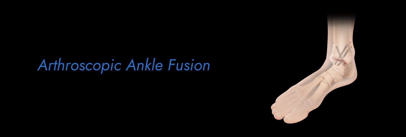 Arthroscopic-Ankle-Fusion-scaled.jpg