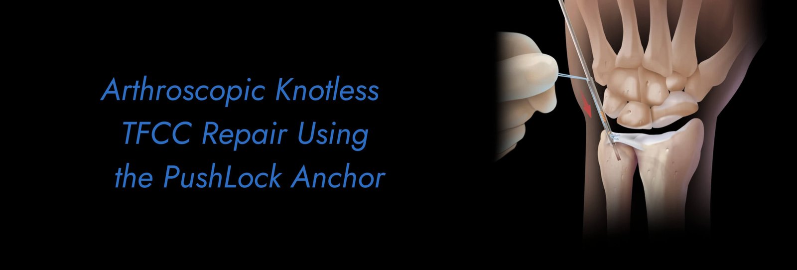 Arthroscopic-Knotless-TFCC-Repair-Using-the-PushLock-Anchor-scaled.jpg