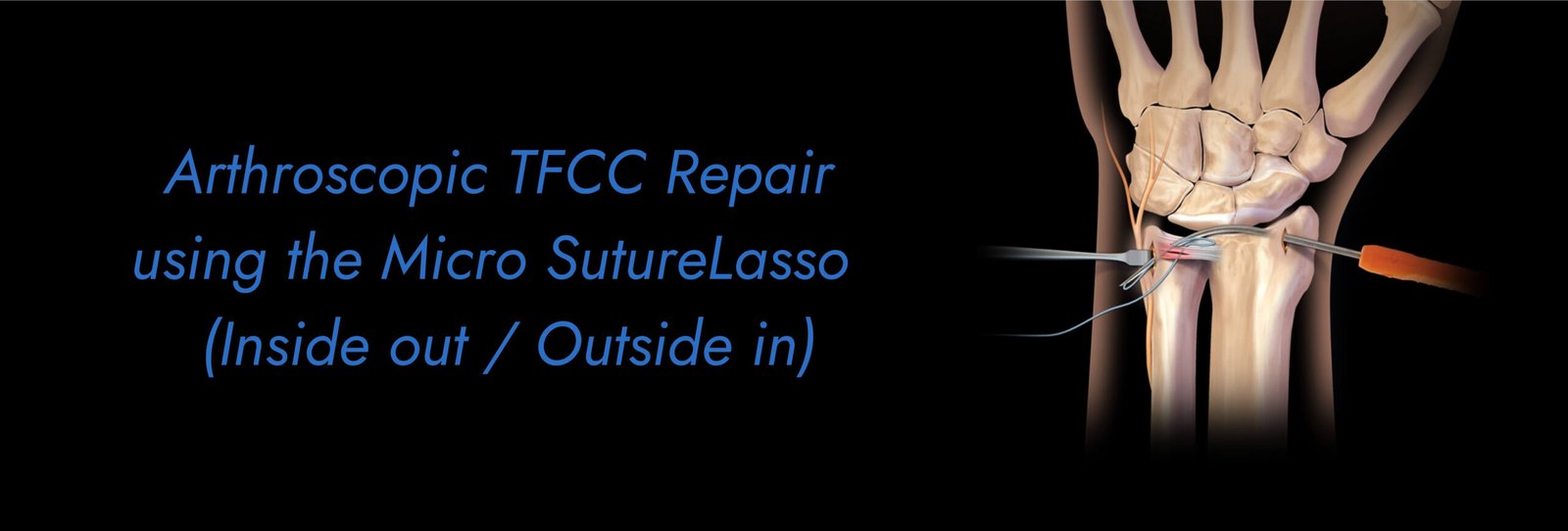 Arthroscopic-TFCC-Repair-using-the-Micro-SutureLasso-Inside-out-_-Outside-in-scaled.jpg