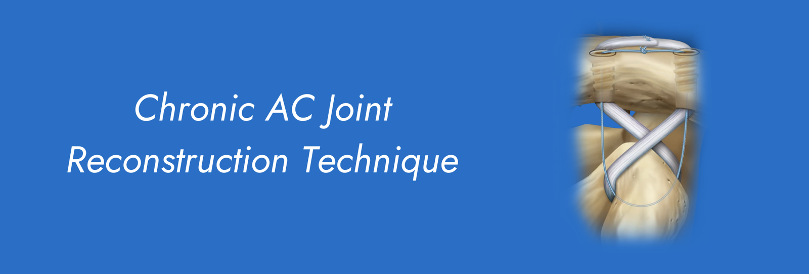 Chronic-AC-Joint-Reconstruction-Technique.png