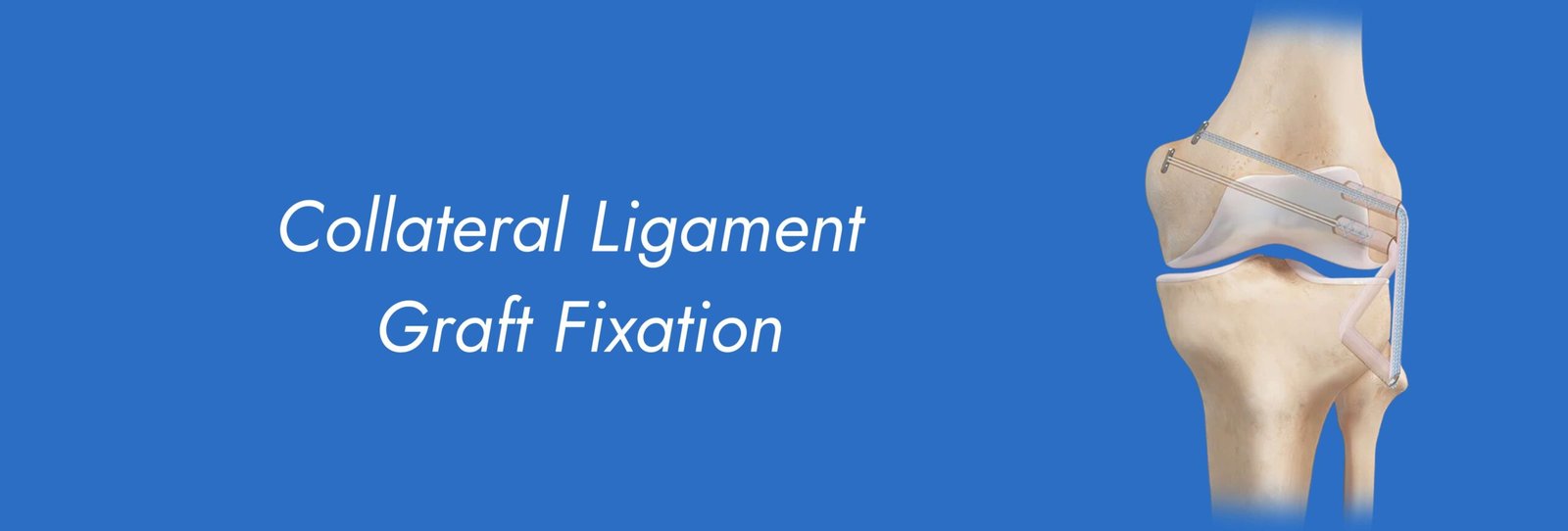 Collateral-Ligament-Graft-Fixation-scaled.jpg