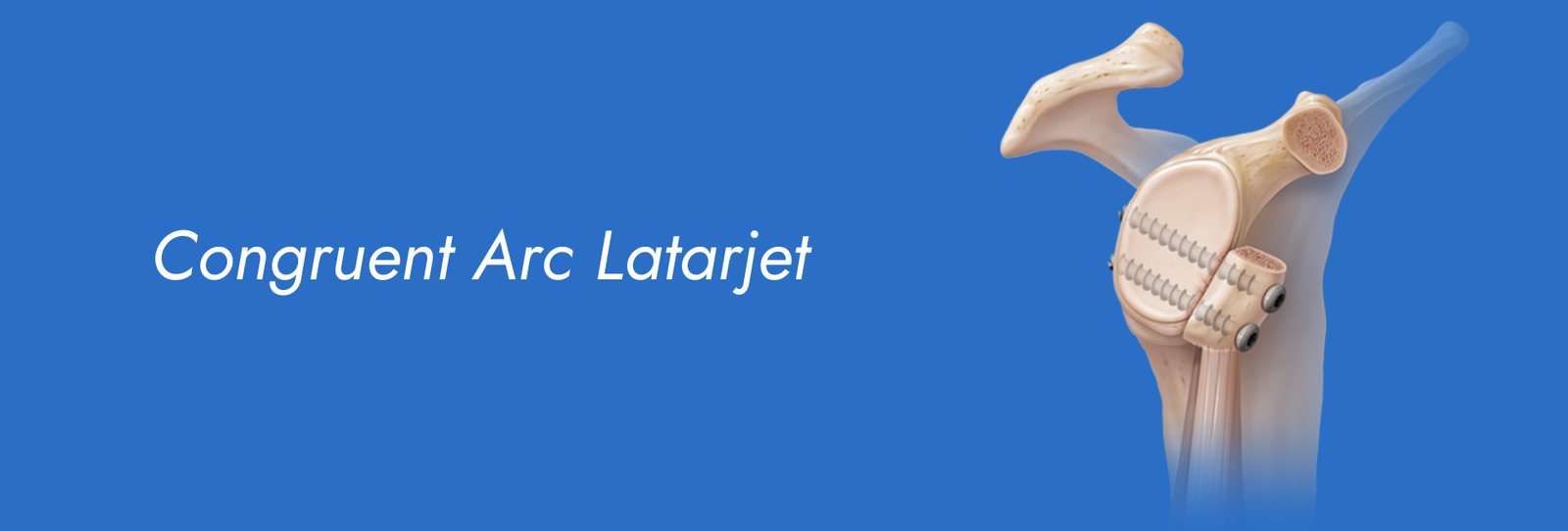 Congruent-Arc-Latarjet.png