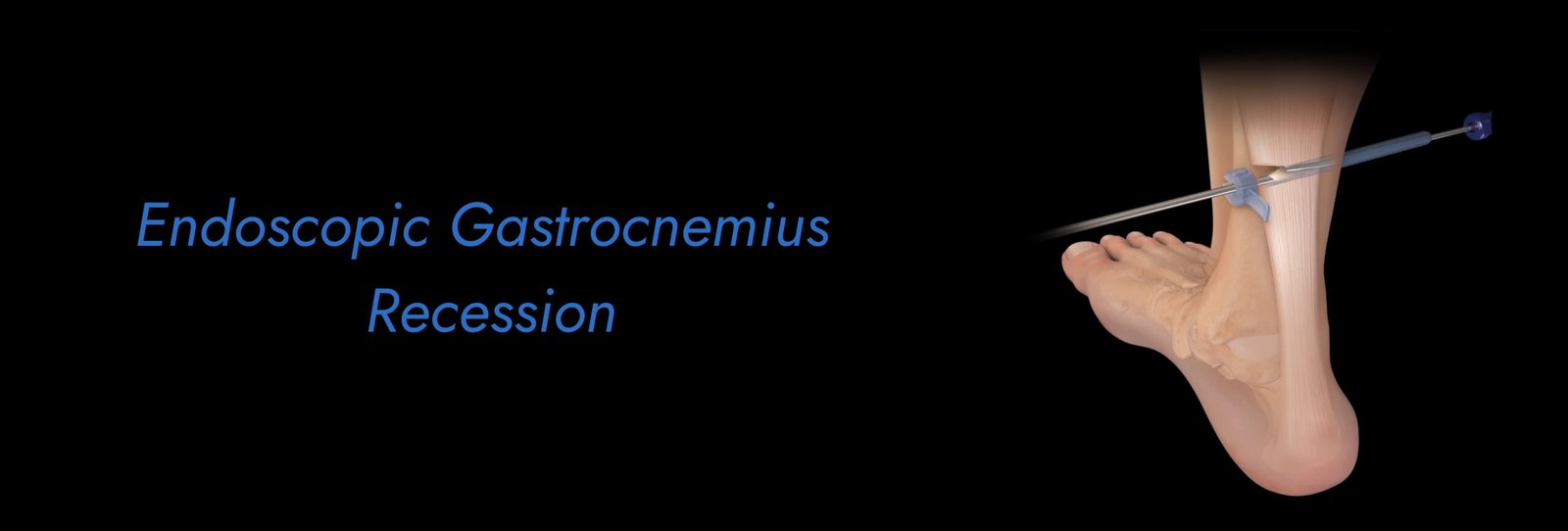 Endoscopic-Gastrocnemius-Recession-scaled.jpg