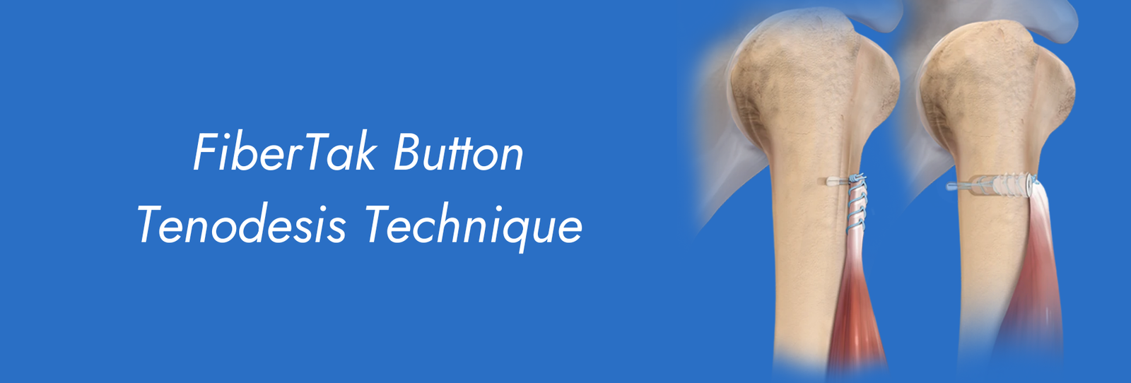 FiberTak-Button-Tenodesis-Technique.png
