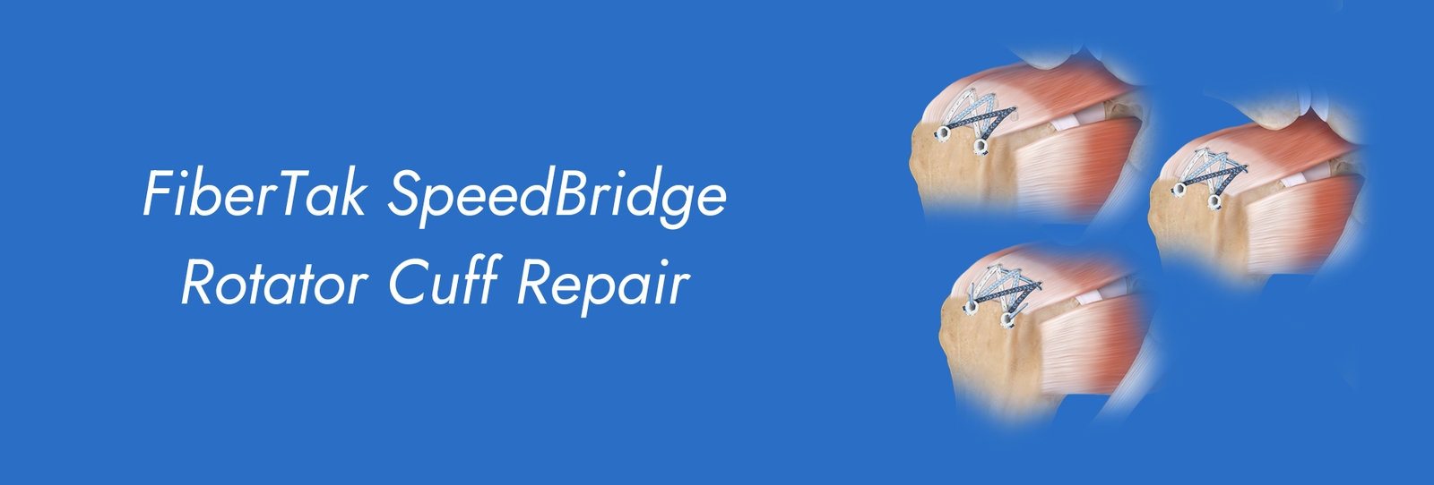 FiberTak-SpeedBridge-Rotator-Cuff-Repair.png