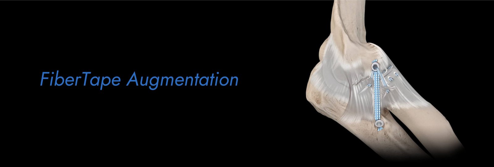 FiberTape-Augmentation-scaled.jpg