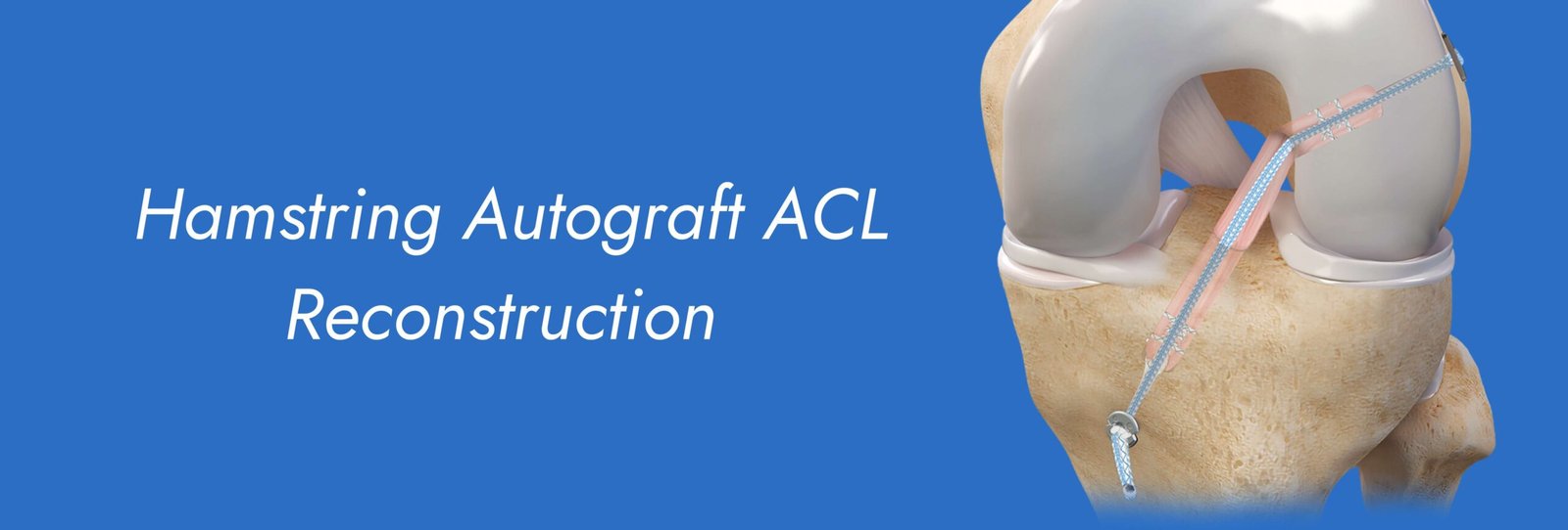 Hamstring-Autograft-ACL-Reconstruction-scaled.jpg
