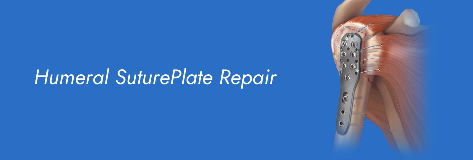 Humeral-Suture-Plate-Repair.png