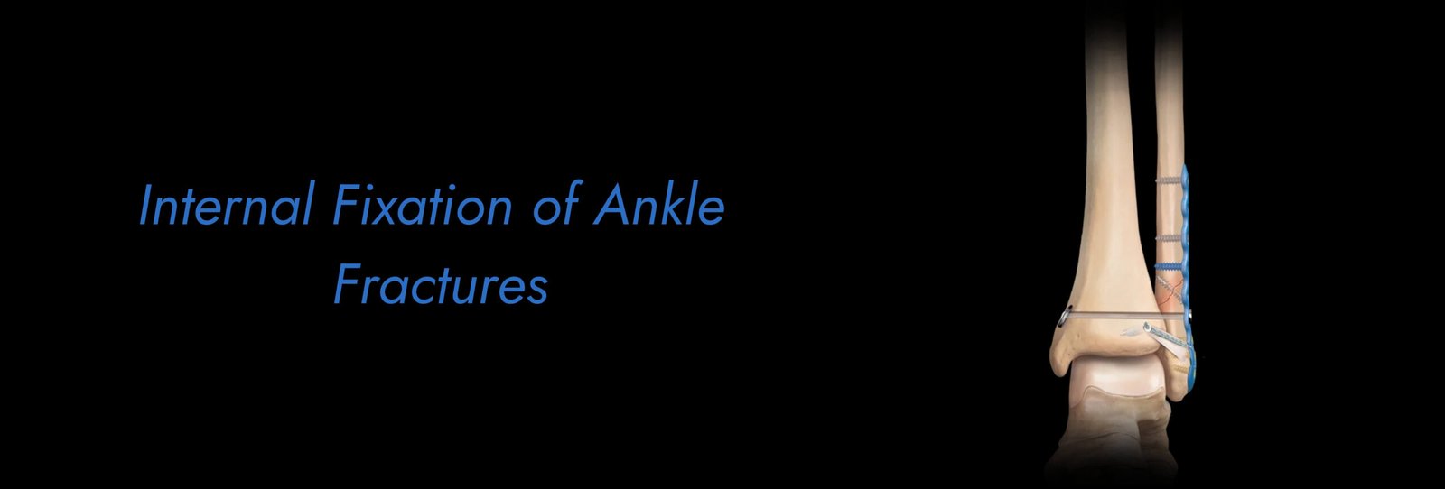 Internal-Fixation-of-Ankle-Fractures-scaled.jpg