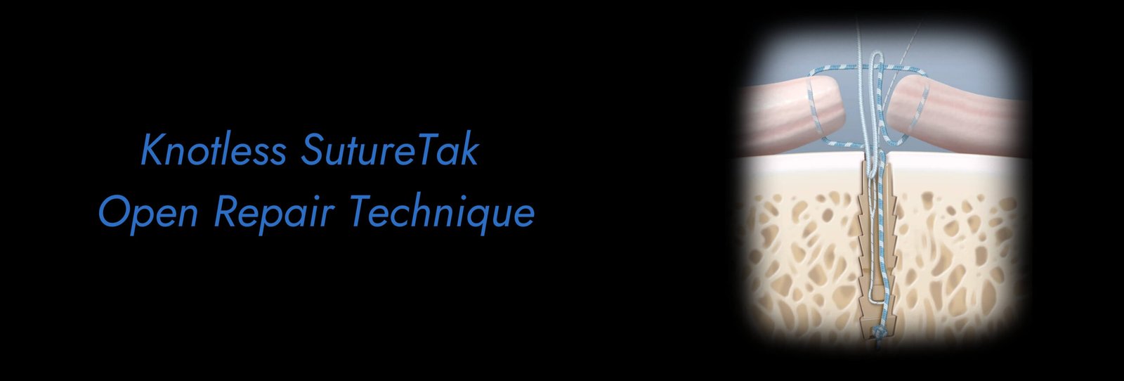 Knotless-SutureTak-Open-Repair-Technique-scaled.jpg