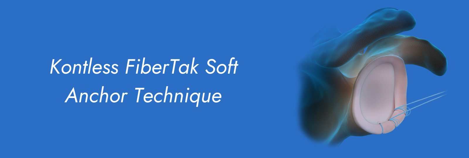 Kontless-Fiber-Tak-Soft-Anchor-Technique.png