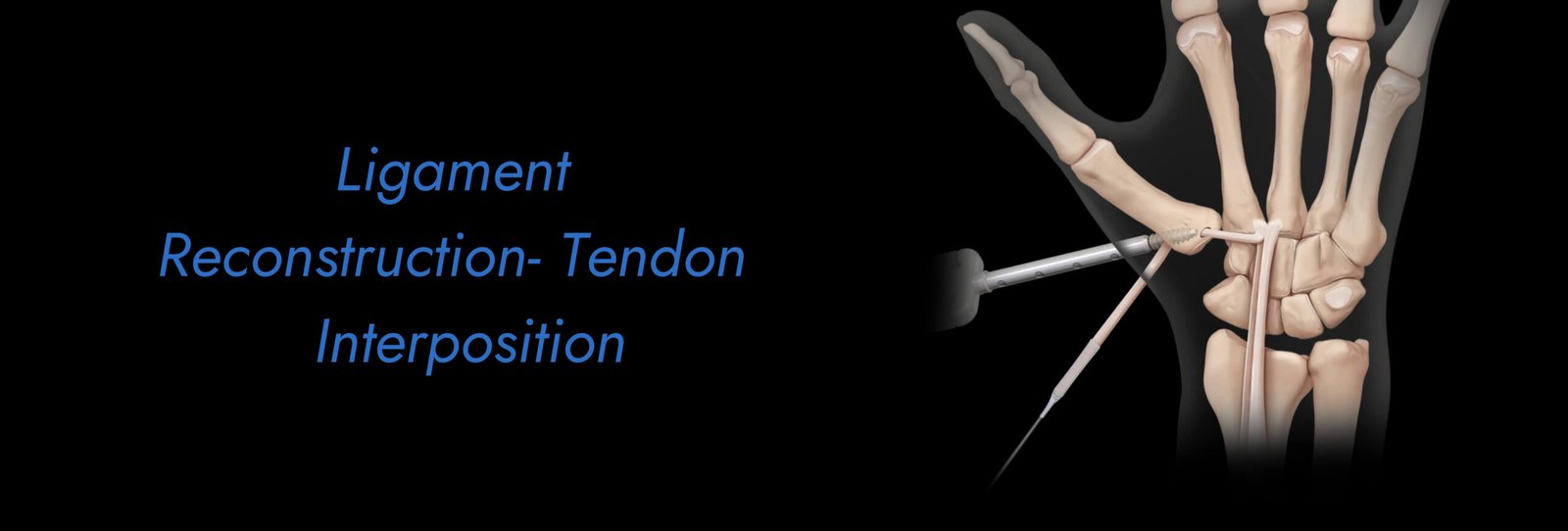 Ligament-Reconstruction-Tendon-Interposition-scaled.jpg