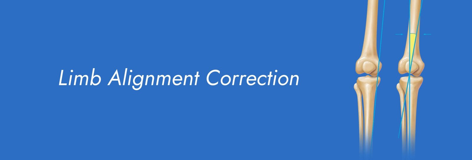 Limb-Alignment-Correction-scaled.jpg
