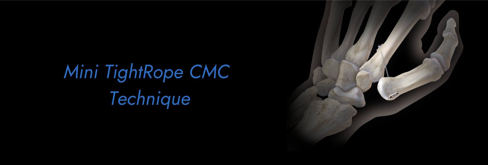 Mini-TightRope-CMC-Technique-scaled.jpg