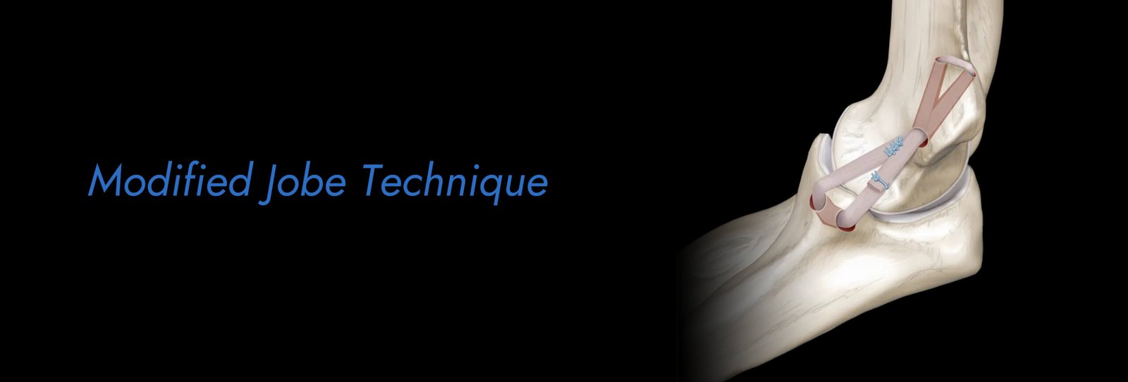 Modified-Jobe-Technique-scaled.jpg