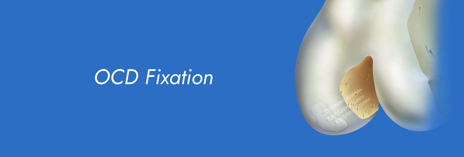 OCD-Fixation-scaled.jpg