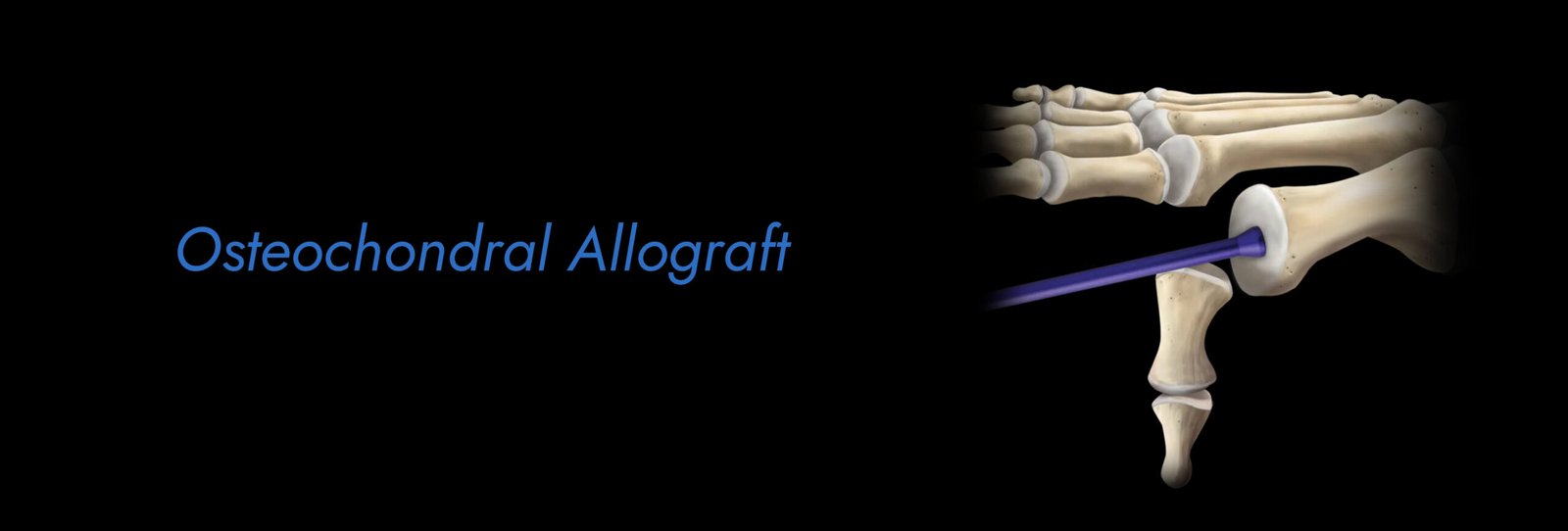 Osteochondral-Allograft-scaled.jpg