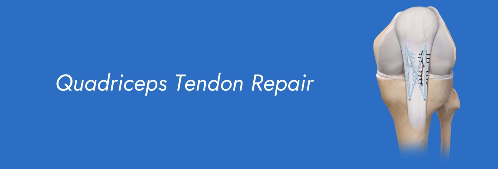 Quadriceps-Tendon-Repair-scaled.jpg