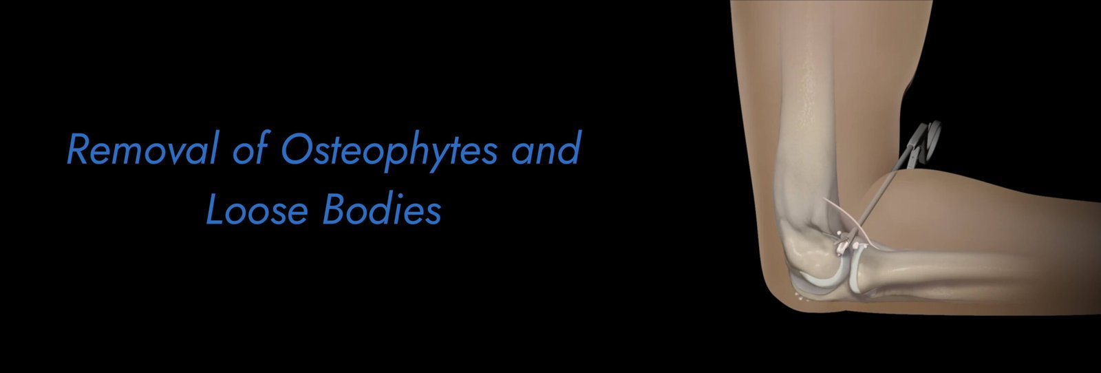 Removal-of-Osteophytes-and-Loose-Bodies-scaled.jpg