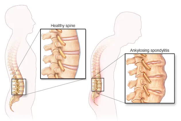 Best Ankylosing Spondylitis Treatment Doctors in Pune India