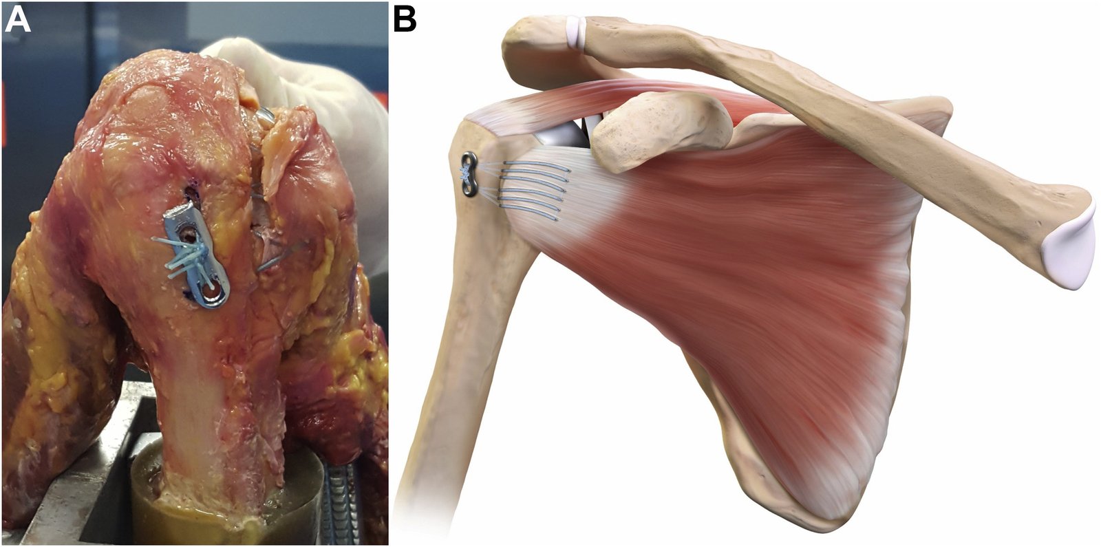 Arthroscopic Subscapularis Repair in Pune, India