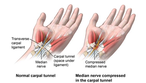 Carpal Tunnel Syndrome Treatment Doctor in Pune India
