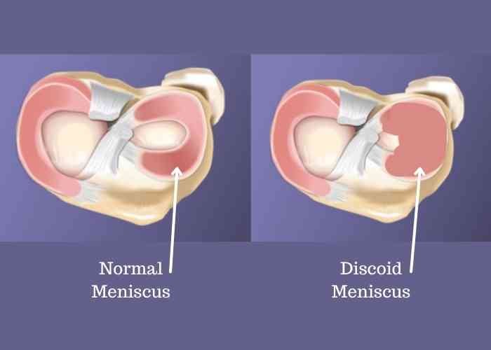 Discoid Meniscus Injury Treatment in Pune, India