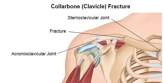 Shoulder Joint Fracture Fixation Treatment in Pune