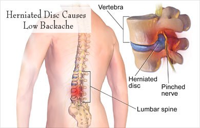 Intervertebral Disc Prolapse Specialist in Pune India