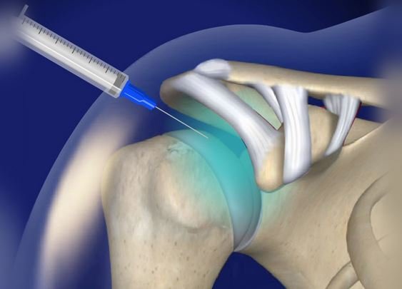 Intra Articular Injection Doctors in Pune India