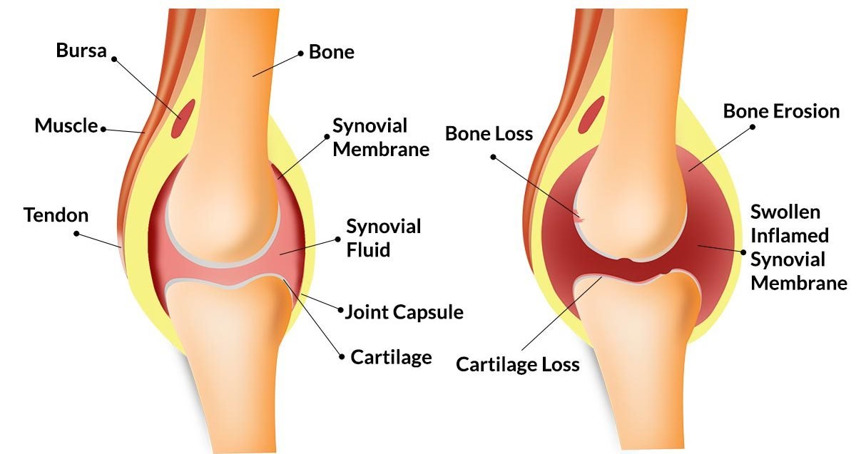 Knee Swelling Treatment in Pune, India