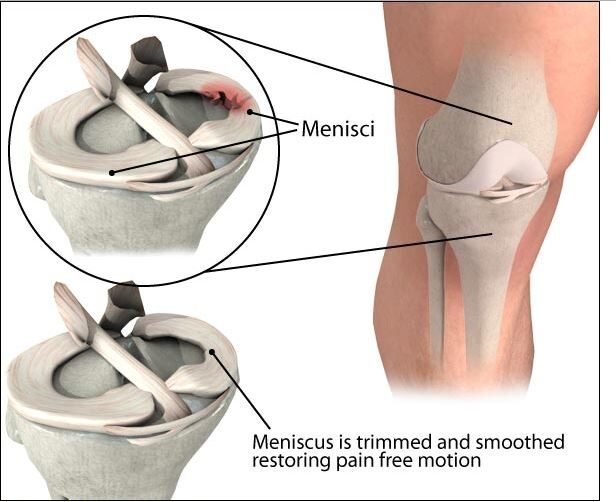 Locking Knee Joint Treatment in Pune, India