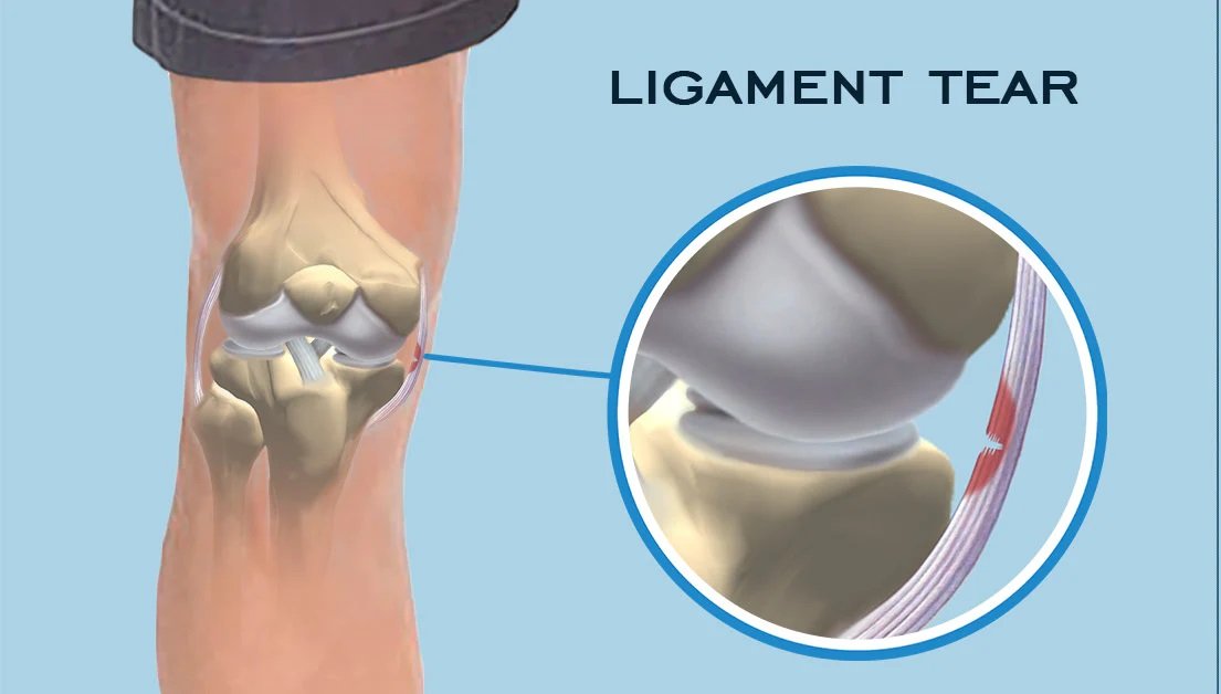 Medial Collateral Ligament (MCL) Injury Treatment Doctor in Pune