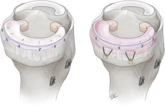 Meniscal Transplant Surgery in Pune, India