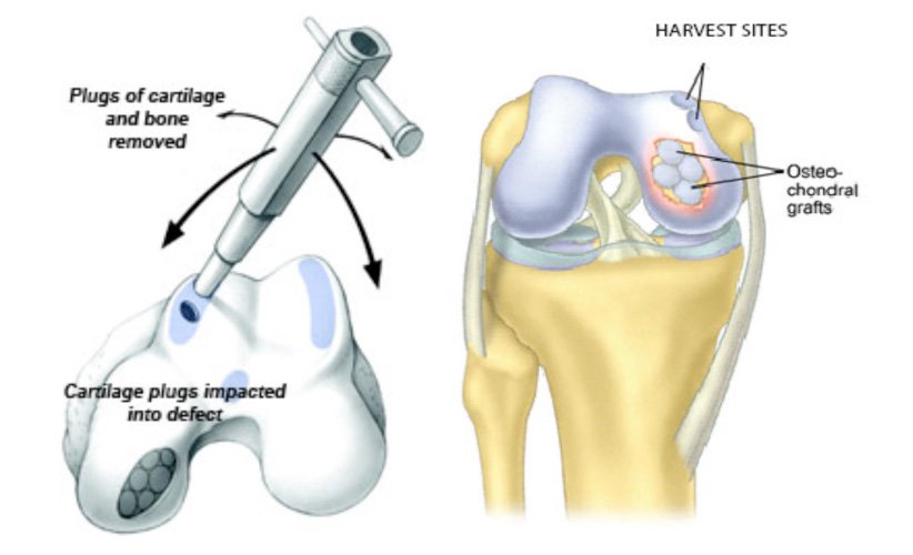 Osteochondral Autografting Mosaicplasty Surgery in Pune