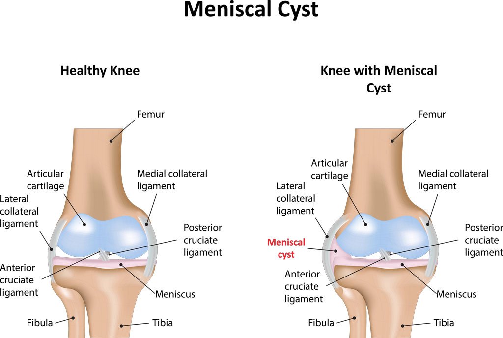 Parameniscal Cyst Treatment in Pune, India
