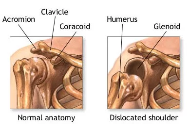 Shoulder Dislocation Treatment Doctors In Pune