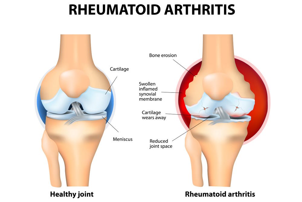Rheumatoid-Arthritis-RA