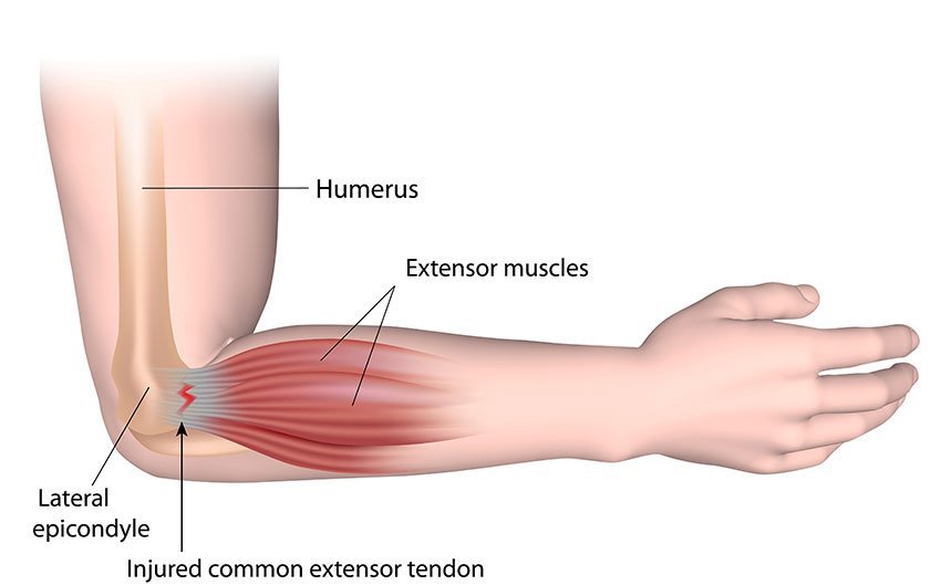 Tennis Elbow Treatment Specialist in Pune India
