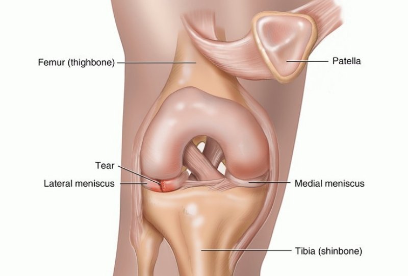 Discoid Meniscus Treatment in Pune, India