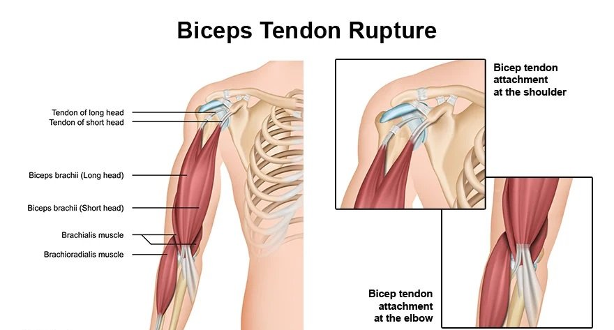 Biceps Tendon Rupture Treatment in Pune