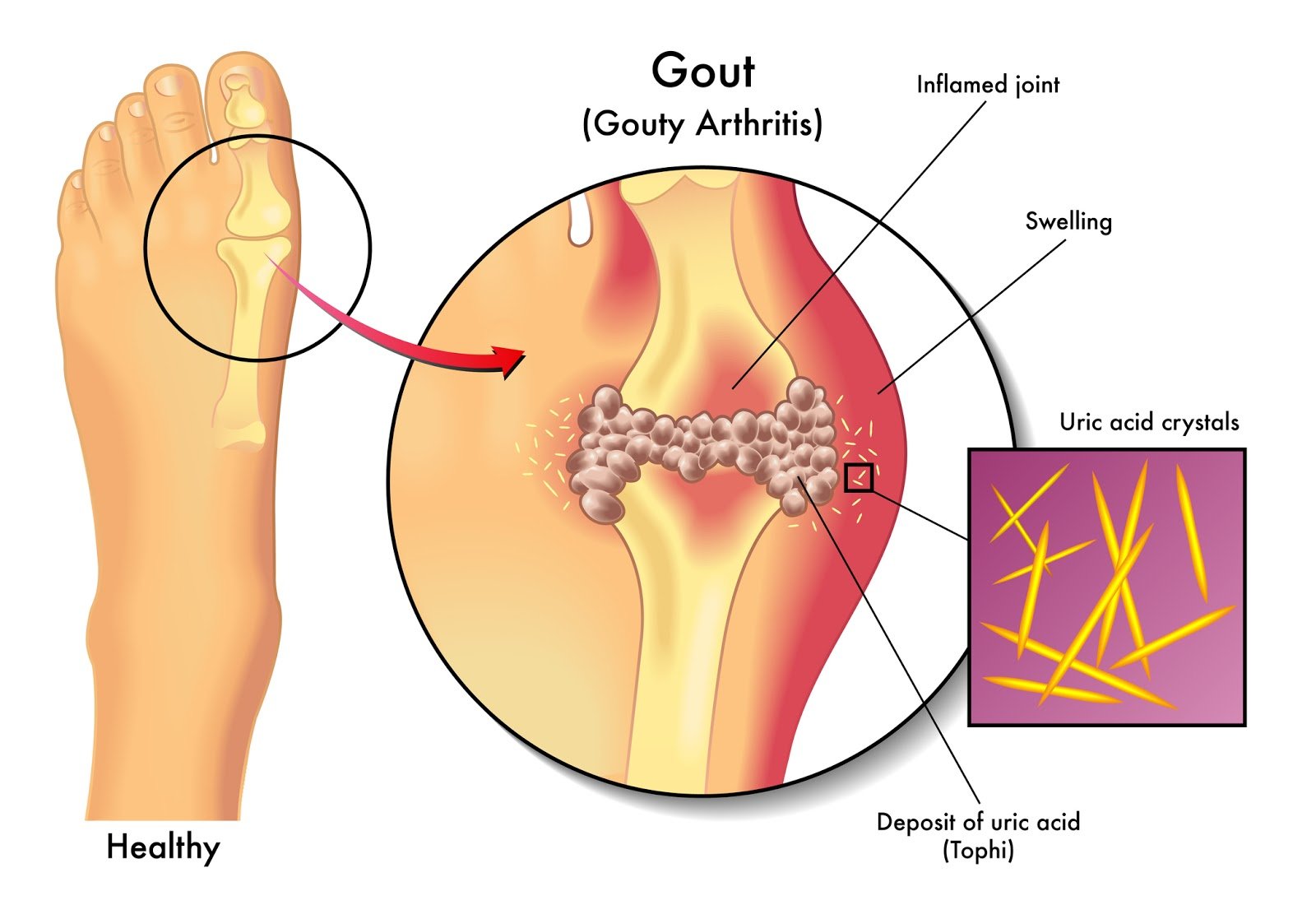 Doctor for Gouty Arthritis in Pune, India