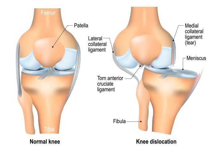 Multiligament Knee Injury Treatment in Pune, India