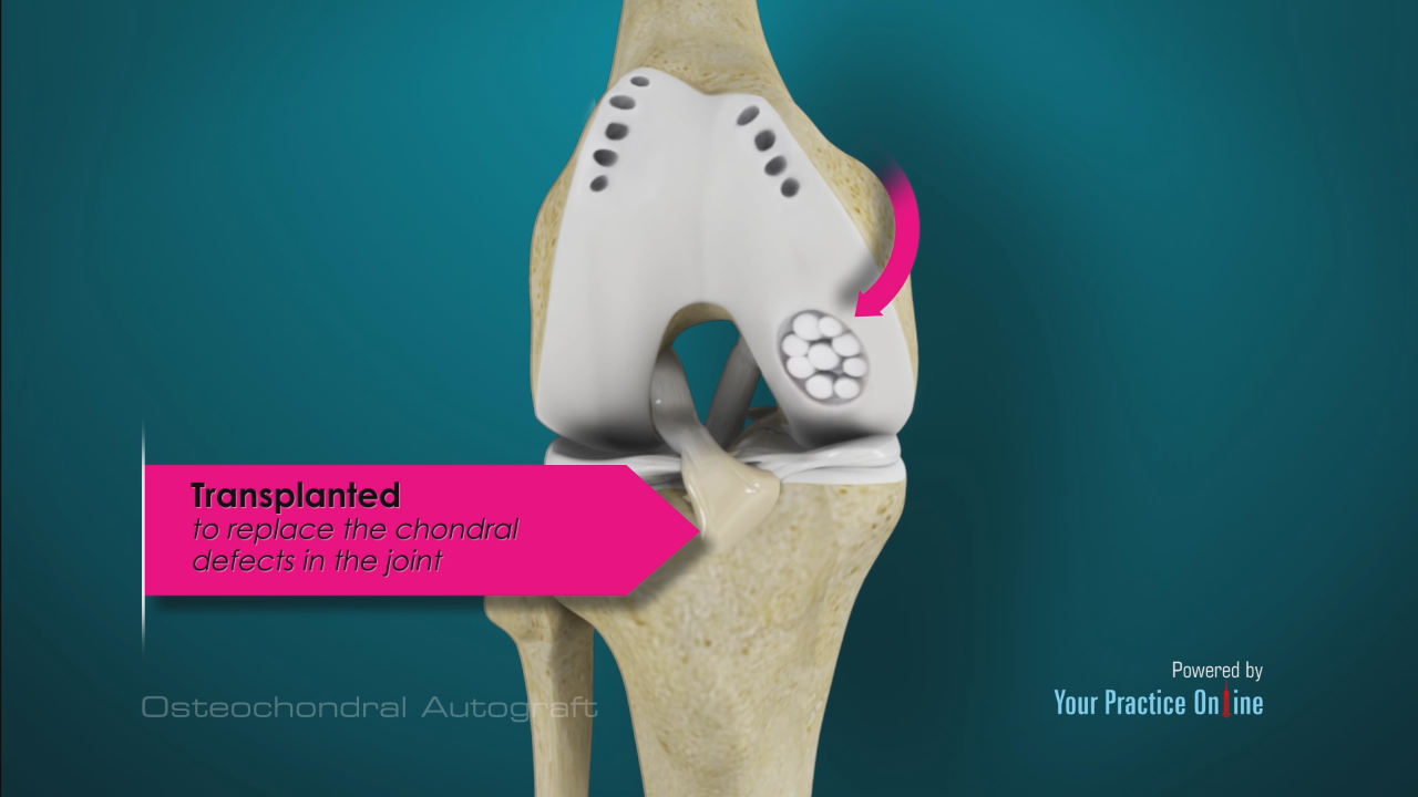 Osteochondral Autografting Mosaicplasty Surgery In Pune, India