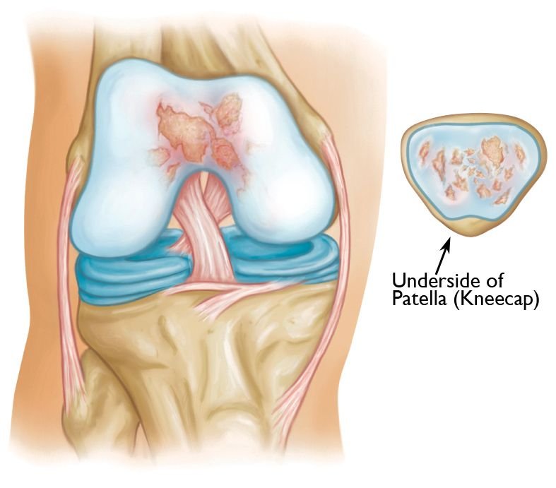 Patellofemoral Arthritis Treatment in Pune, India
