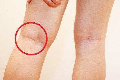 Doctor For Swollen Knee Treatment in Pune, India